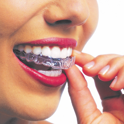 Invisaligninsertingtrays Gig Harbor Orthodontics