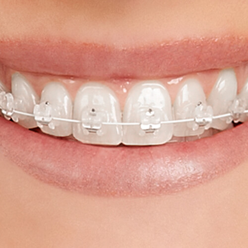 Teeth Empower clear braces