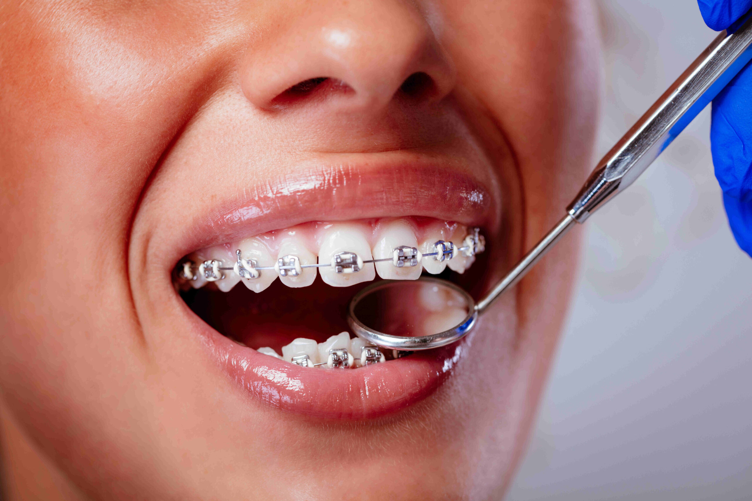 Lingual Braces vs Traditional Braces: Pros and Cons