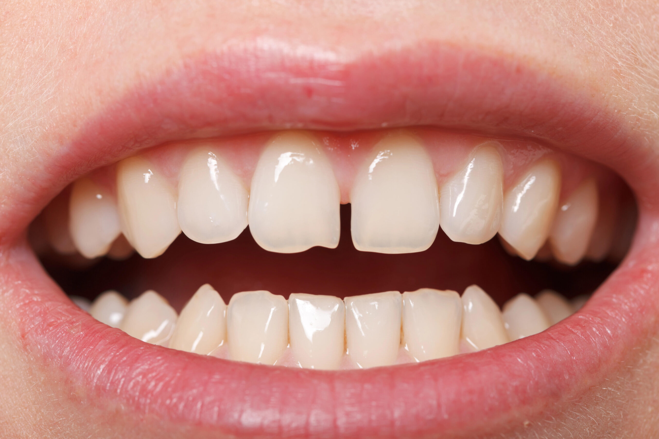 Invisalign for Gap Teeth: Close Gaps Seamlessly